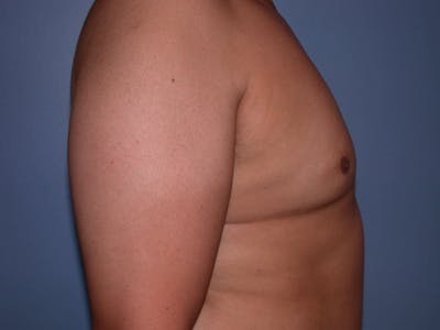 Gynecomastia Gallery Before & After Gallery - Patient 4757286 - Image 2