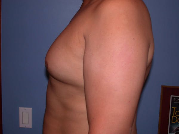 Gynecomastia Gallery Before & After Gallery - Patient 4757286 - Image 3
