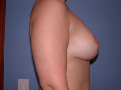 Breast Lift Gallery Before & After Gallery - Patient 4757284 - Image 6