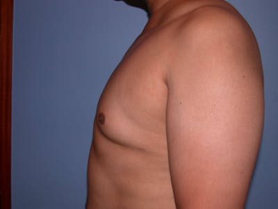 Gynecomastia Gallery Before & After Gallery - Patient 4757286 - Image 4