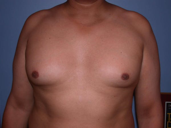 Gynecomastia Gallery Before & After Gallery - Patient 4757286 - Image 5