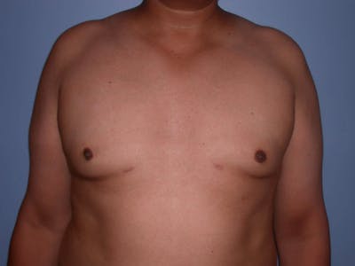 Gynecomastia Gallery Before & After Gallery - Patient 4757286 - Image 6