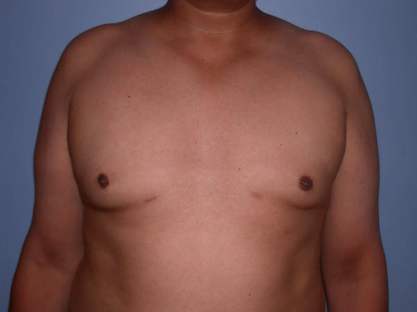 Gynecomastia Gallery Before & After Gallery - Patient 4757286 - Image 6