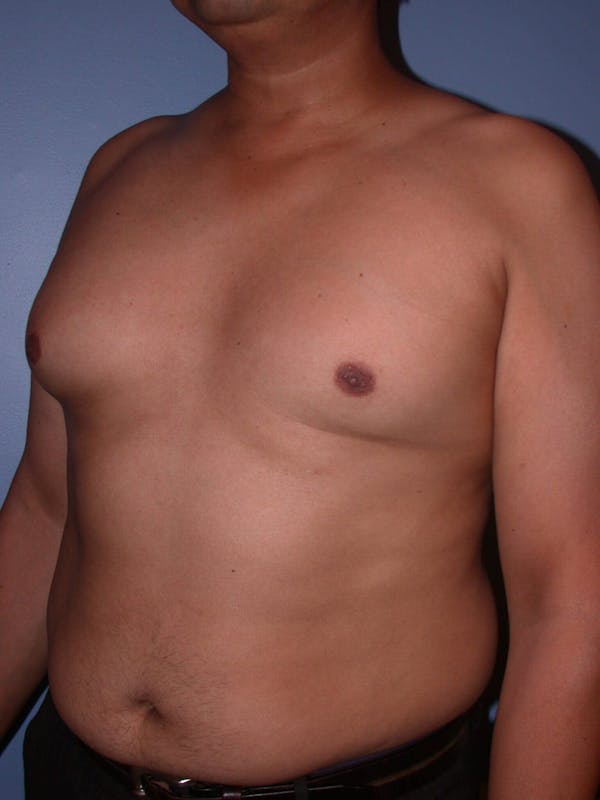 Gynecomastia Gallery Before & After Gallery - Patient 4757286 - Image 7