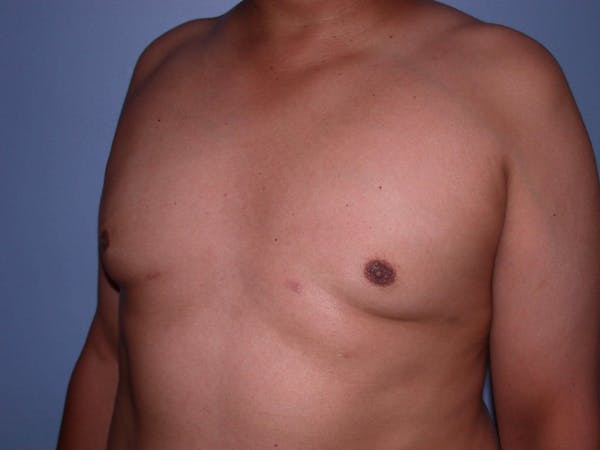 Gynecomastia Gallery Before & After Gallery - Patient 4757286 - Image 8