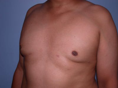 Gynecomastia Before & After Gallery - Patient 4757286 - Image 8