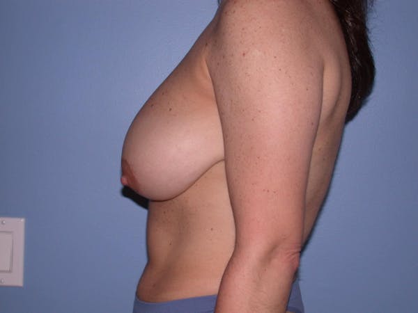 Breast Reduction Gallery Before & After Gallery - Patient 4757297 - Image 3