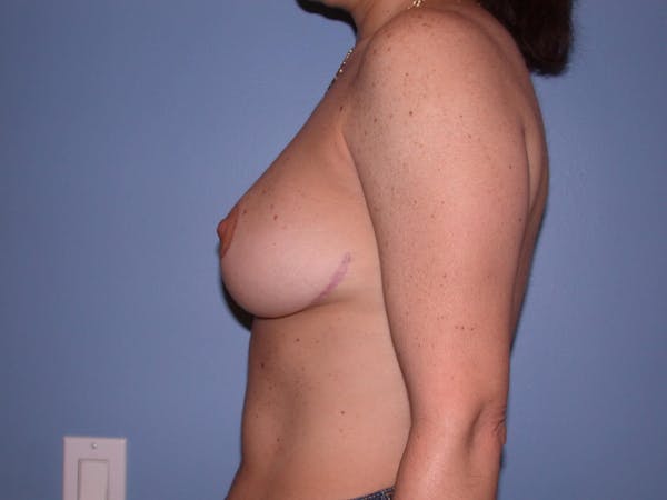 Breast Reduction Before & After Gallery - Patient 4757297 - Image 4