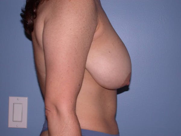 Breast Reduction Gallery Before & After Gallery - Patient 4757297 - Image 5