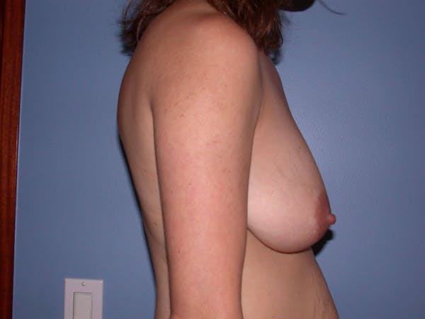 Breast Lift Gallery Before & After Gallery - Patient 4757299 - Image 5
