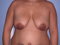 Breast Reduction Gallery Before & After Gallery - Patient 4757302 - Image 1