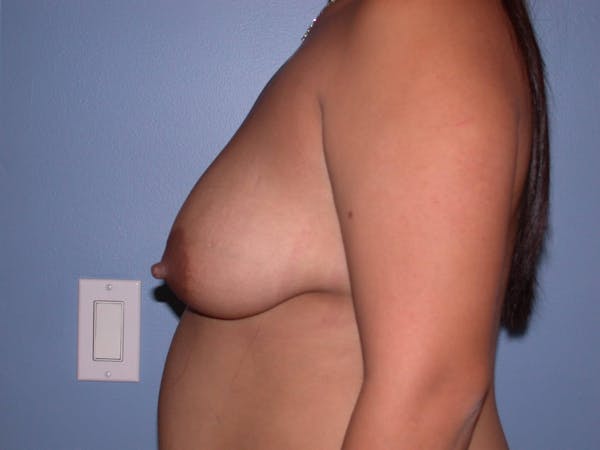 Breast Reduction Gallery Before & After Gallery - Patient 4757302 - Image 3