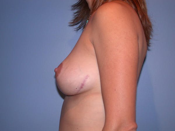 Breast Lift Gallery Before & After Gallery - Patient 4757299 - Image 8