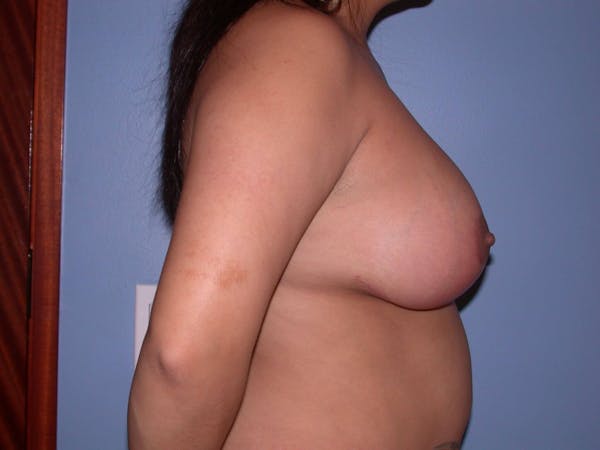 Breast Reduction Gallery Before & After Gallery - Patient 4757302 - Image 6