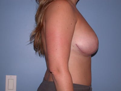 Breast Reduction Gallery Before & After Gallery - Patient 4757307 - Image 4