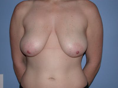 Breast Reduction Gallery Before & After Gallery - Patient 4757314 - Image 1