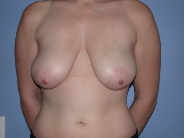 Breast Reduction Gallery Before & After Gallery - Patient 4757314 - Image 1