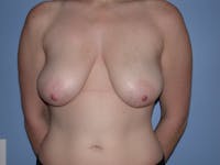 Breast Reduction Before & After Gallery - Patient 4757314 - Image 1