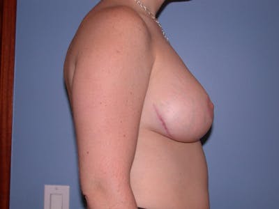 Breast Reduction Before & After Gallery - Patient 4757314 - Image 4