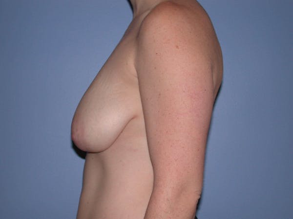 Breast Reduction Gallery Before & After Gallery - Patient 4757314 - Image 5