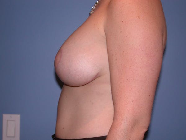 Breast Reduction Before & After Gallery - Patient 4757314 - Image 6