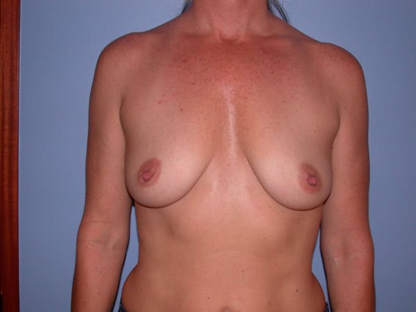 Breast Augmentation Before & After Gallery - Patient 4757331 - Image 1