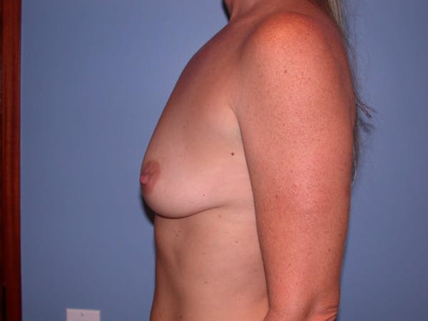Breast Augmentation Gallery Before & After Gallery - Patient 4757331 - Image 3