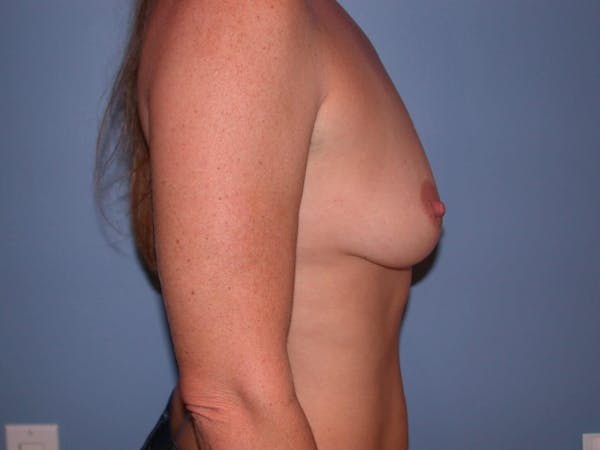Breast Augmentation Gallery Before & After Gallery - Patient 4757331 - Image 5