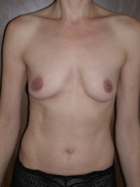 Breast Augmentation Gallery Before & After Gallery - Patient 4757351 - Image 1