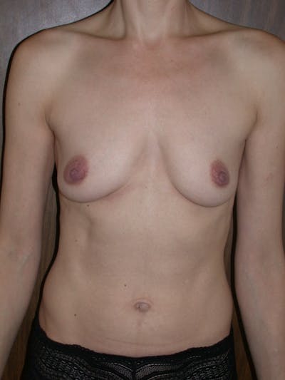 Breast Augmentation Before & After Gallery - Patient 4757351 - Image 1