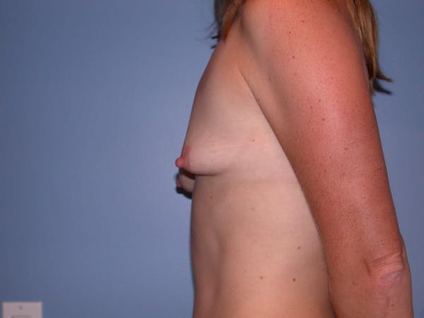 Breast Augmentation Gallery Before & After Gallery - Patient 4757383 - Image 3