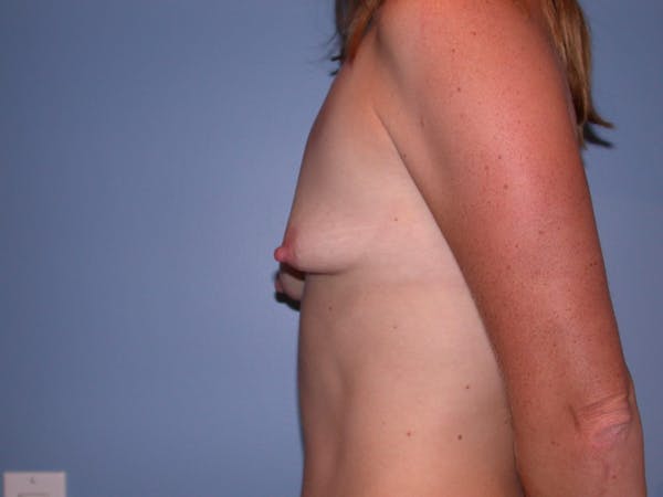 Breast Augmentation Gallery - Patient 4757383 - Image 3