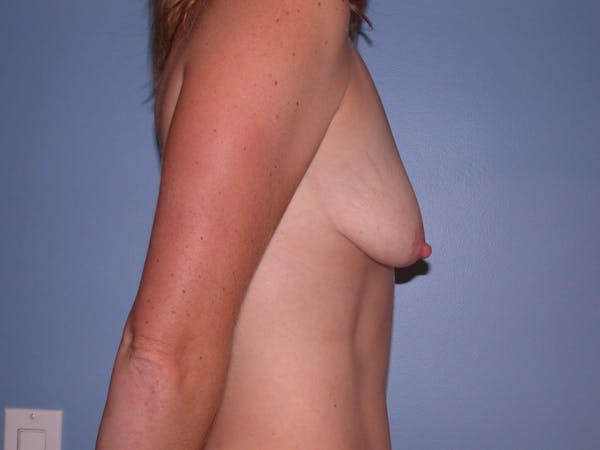 Breast Augmentation Before & After Gallery - Patient 4757383 - Image 5