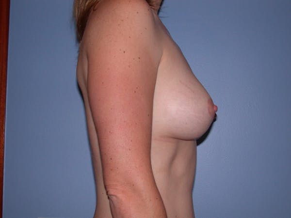 Breast Augmentation Gallery Before & After Gallery - Patient 4757383 - Image 6