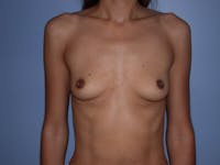 Breast Augmentation Gallery Before & After Gallery - Patient 4757387 - Image 1