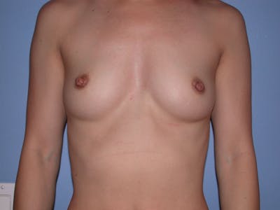 Breast Augmentation Before & After Gallery - Patient 4757395 - Image 1