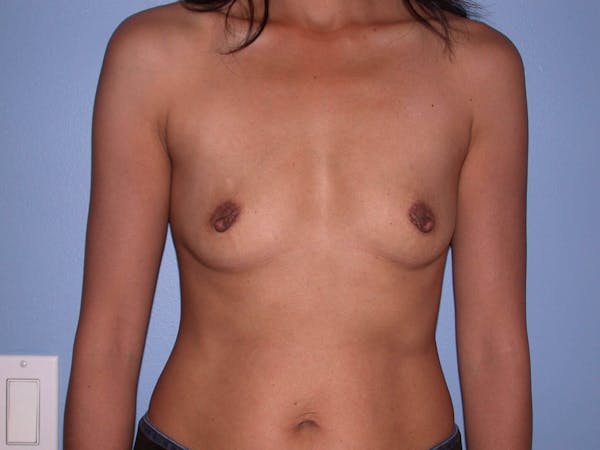 Breast Augmentation Gallery Before & After Gallery - Patient 4757405 - Image 1