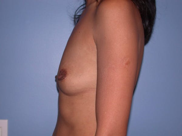Breast Augmentation Gallery Before & After Gallery - Patient 4757405 - Image 5
