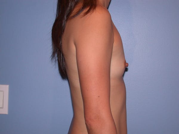 Breast Augmentation Gallery Before & After Gallery - Patient 4757408 - Image 5