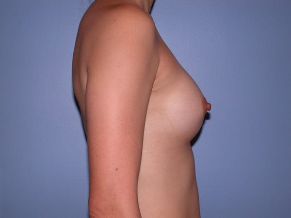 Breast Augmentation Before & After Gallery - Patient 4757408 - Image 6