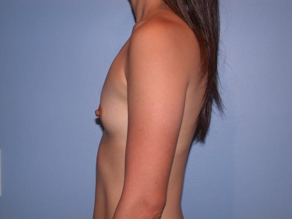 Breast Augmentation Gallery Before & After Gallery - Patient 4757408 - Image 7