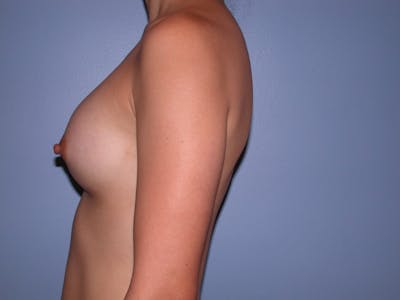 Breast Augmentation Gallery Before & After Gallery - Patient 4757408 - Image 8