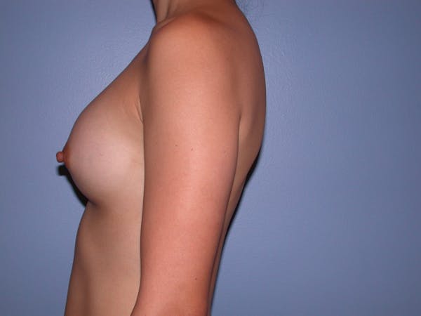 Breast Augmentation Gallery Before & After Gallery - Patient 4757408 - Image 8