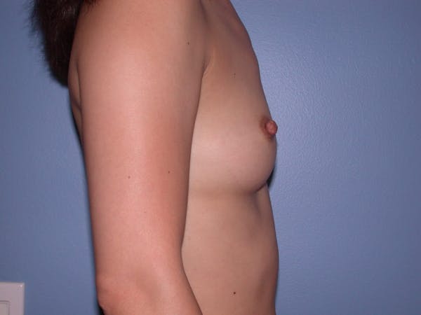 Breast Augmentation Before & After Gallery - Patient 4757503 - Image 3