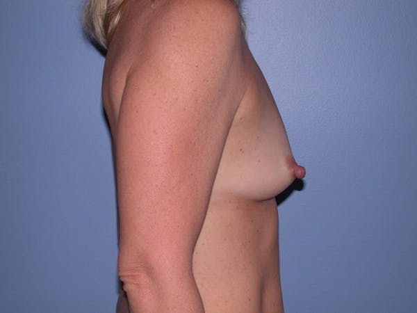 Breast Augmentation Gallery Before & After Gallery - Patient 4757512 - Image 3