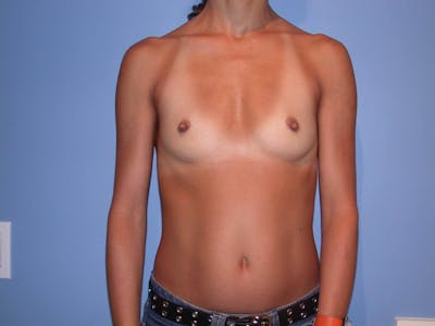 Breast Augmentation Gallery Before & After Gallery - Patient 4757531 - Image 1