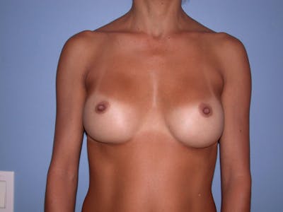 Breast Augmentation Gallery Before & After Gallery - Patient 4757531 - Image 2