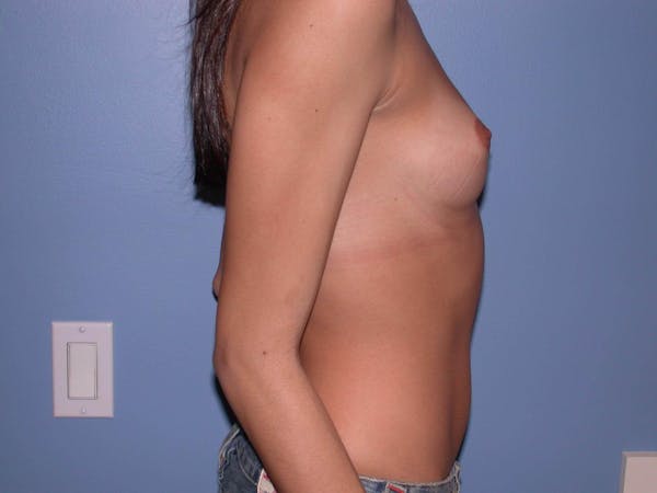 Breast Augmentation Gallery Before & After Gallery - Patient 4757539 - Image 3