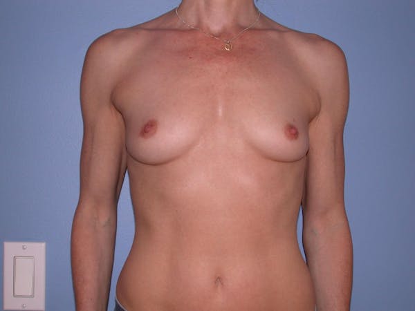 Breast Augmentation Gallery Before & After Gallery - Patient 4757544 - Image 1