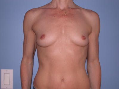 Breast Augmentation Gallery Before & After Gallery - Patient 4757544 - Image 1